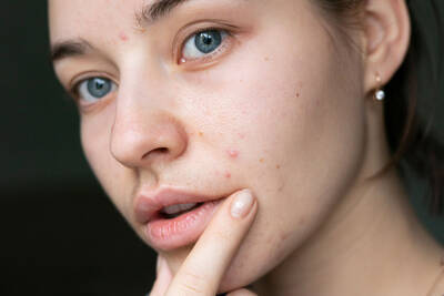 isotretinoina para acne