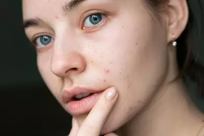 isotretinoina para acne