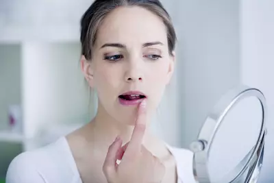Mulher com dermatite perioral ao redor da boca, representando a origem da condicao e como trata-la.