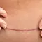 Foto de uma pele com queloide, um tipo de cicatriz elevada e espessa que pode surgir apos lesoes na pele.