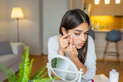 Mulher com marcas de espinhas no rosto, com dicas para minimizar e evitar o aparecimento de cicatrizes de acne.
