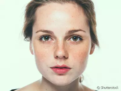 Close-up de rosto com rosacea, mostrando antes e depois do tratamento