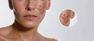 Produtos com acido kojico ajudam a tratar manchas de sol, melasma e acne.