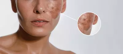 Produtos com acido kojico ajudam a tratar manchas de sol, melasma e acne.