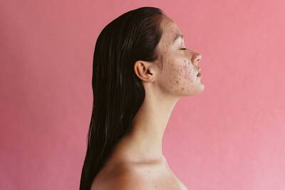 A vitamina C ajuda uniformizar o tom da pele com manchas de acne