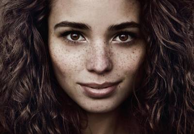 Rosto com diferentes tipos de manchas na pele: melasma, acne e sardas.