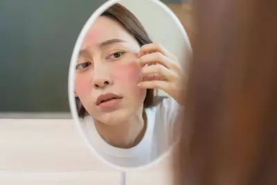 Rosacea e dermatite podem causar mancha vermelha na pele do rosto