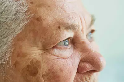 Mulher mais velha com manchas na pele