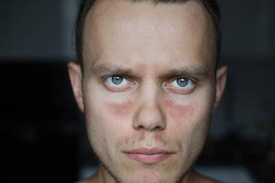 Homem com lupus