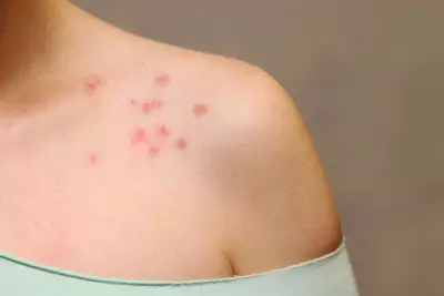 Saiba o que pode ser manchas vermelhas no corpo que cocam e se espalham