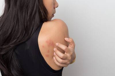 fotos de alergia na pele que cocam