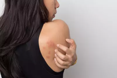 fotos de alergia na pele que cocam