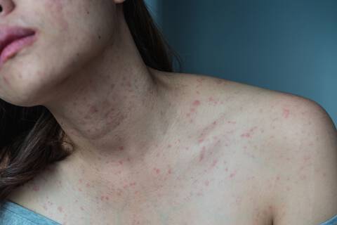Alergias na pele: conheça as mais comuns e descubra como evitar e