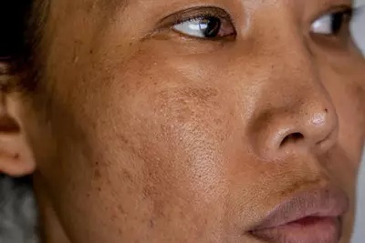 Mulher com melasma no rosto