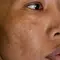 Mulher com melasma no rosto