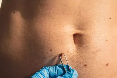 Cancer de pele: saiba os sintomas e quais sao os tratamentos - Dermaclub