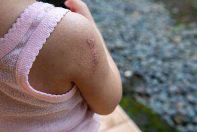 Crianca com impetigo no ombro