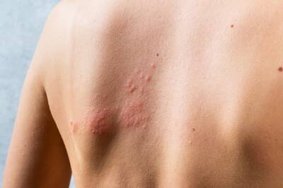 Costas de uma pessoa com dermatite de contato, uma reacao alergica causada pelo contato com substancias irritantes.