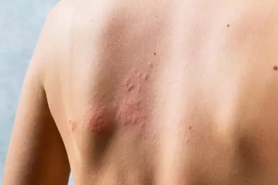 Costas de uma pessoa com dermatite de contato, uma reacao alergica causada pelo contato com substancias irritantes.