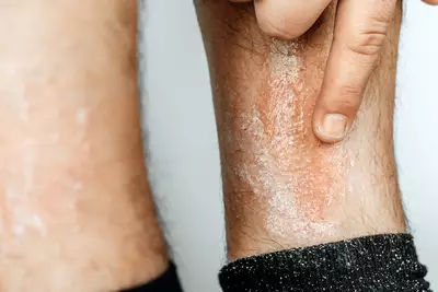 Fungo na pele: saiba identificar - Dermaclub