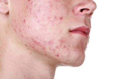 Pessoa com acne grau 3