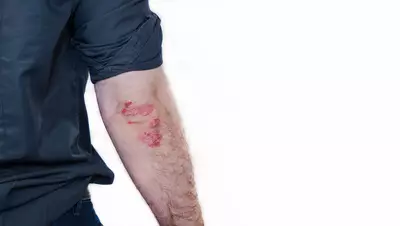 Manchas vermelhas na pele que cocam - Dermaclub