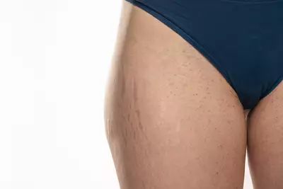 Mulher cuidando da pele na regiao da virilha para tratar foliculite e evitar manchas escuras