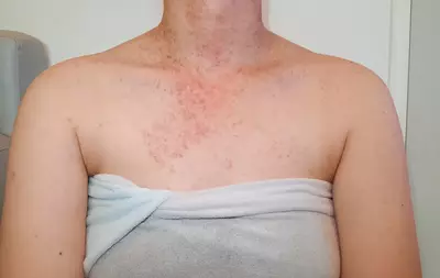 Foto de uma pele com foliculite, uma inflamacao nos foliculos pilosos causada por bacterias ou fungos.