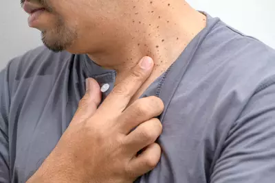 Ceratose Seborreica