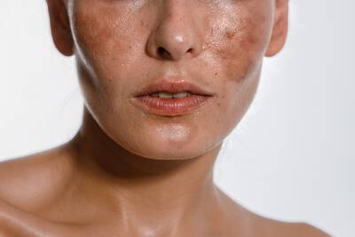 Rosto de mulher com manchas escuras e irregulares, um sinal de hiperpigmentacao.