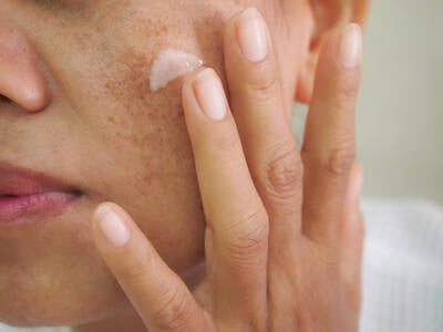 Foto de uma pele com melasma, uma condicao caracterizada por manchas escuras no rosto, comum durante a gravidez.