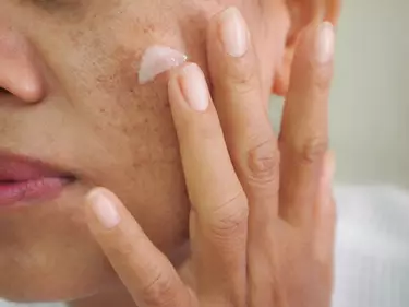 Mulher aplicando creme para melasma