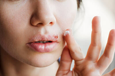 Ferida aberta com crosta no labio, um sintoma caracteristico do virus herpes labial.