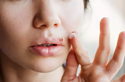 Ferida aberta com crosta no labio, um sintoma caracteristico do virus herpes labial.