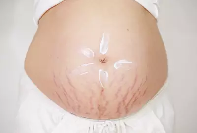 Mulher cuidando de estrias vermelhas.