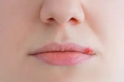 Herpes labial: saiba o que e e como cuidar - Dermaclub