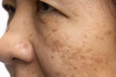 Mulher com melasma no rosto