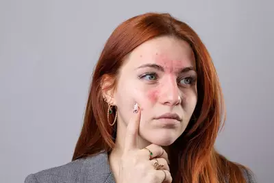 mulher com dermatite seborreica no rosto