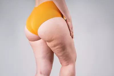 Mulher com celulite na perna, procurando como diminuir celulite