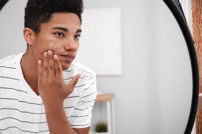 Pessoa com espinhas e acne no rosto, uma condicao comum que pode afetar a autoestima e a qualidade de vida.