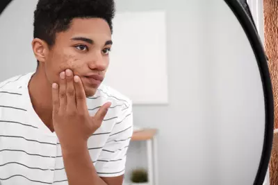 Pessoa com espinhas e acne no rosto, uma condicao comum que pode afetar a autoestima e a qualidade de vida.
