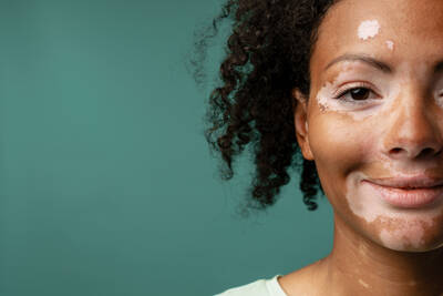 Foto de uma pele com vitiligo, uma condicao caracterizada pela perda de pigmentacao em algumas areas do corpo.