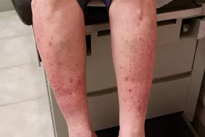 Dermatite herpetiforme imagens​