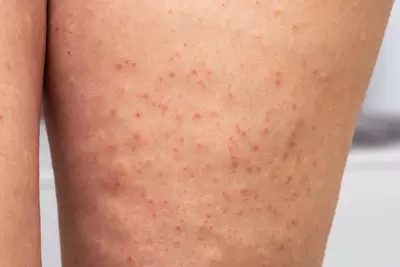 Pessoa com foliculite na perna, uma condicao inflamatoria dos foliculos pilosos.