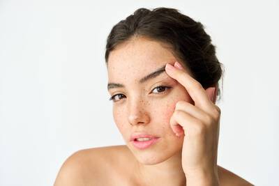Mulher jovem com toxina botulinica aplicada na testa