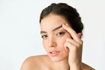 Mulher jovem com toxina botulinica aplicada na testa