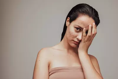 Mulher aprendendo sobre o tratamento de espinhas.