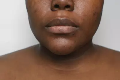 Mulher cuidando de manchas na pele negra.