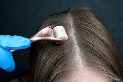Mulher realizando procedimento de microagulhamento capilar