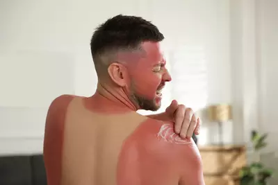 Homem com queimadura solar